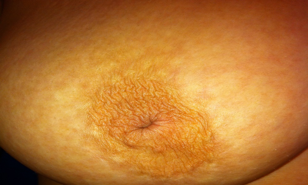 Tụt núm vú - Hình ảnh minh họa